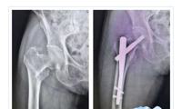 【中医院故事】103岁患者成功手术，刷新柯桥区中医医院骨科手术患者年龄记录！