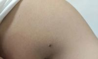 山林游玩莫大意 蜱虫叮咬险酿祸