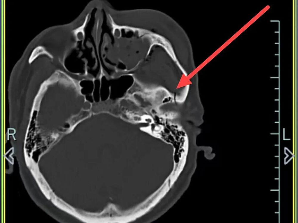 外侧壁、左眼眶外侧壁骨折、左侧颌面部软组织肿胀,软组织内积气 外侧壁、左眼眶外侧壁骨折、左侧颌面部软组织肿胀,软组织内积气