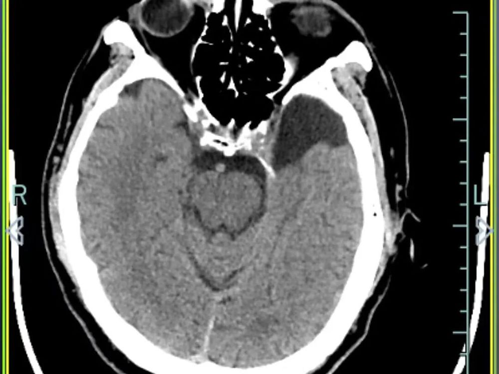 △10月4日CT复查显示,孙先生颅内出血全部吸收,骨折位置没有移位 △10月4日CT复查显示,孙先生颅内出血全部吸收,骨折位置没有移位