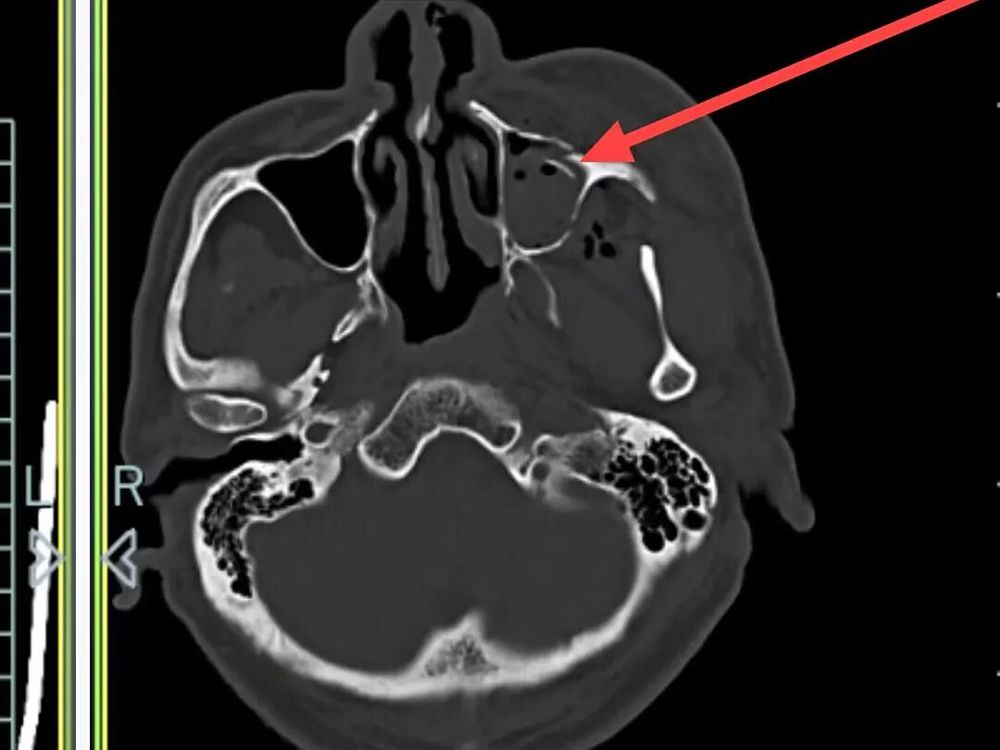 左侧颞骨、左侧颧弓、左侧上颌窦前壁骨折 左侧颞骨、左侧颧弓、左侧上颌窦前壁骨折
