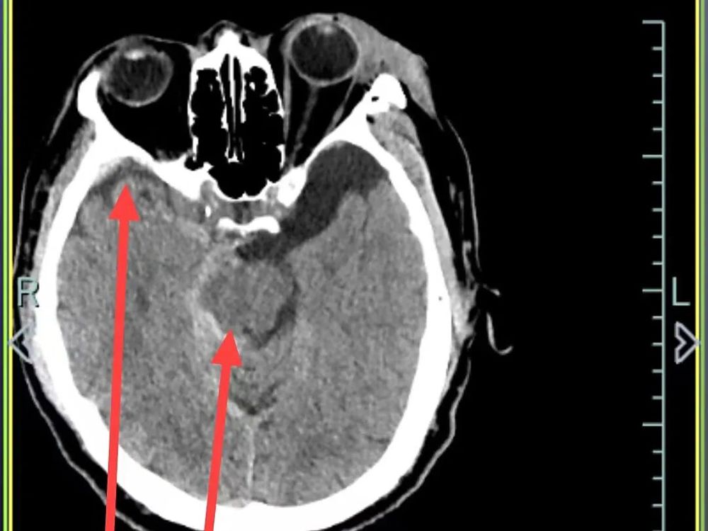 硬膜下出血、蛛网膜下腔出血和多发性创伤性脑出血 硬膜下出血、蛛网膜下腔出血和多发性创伤性脑出血